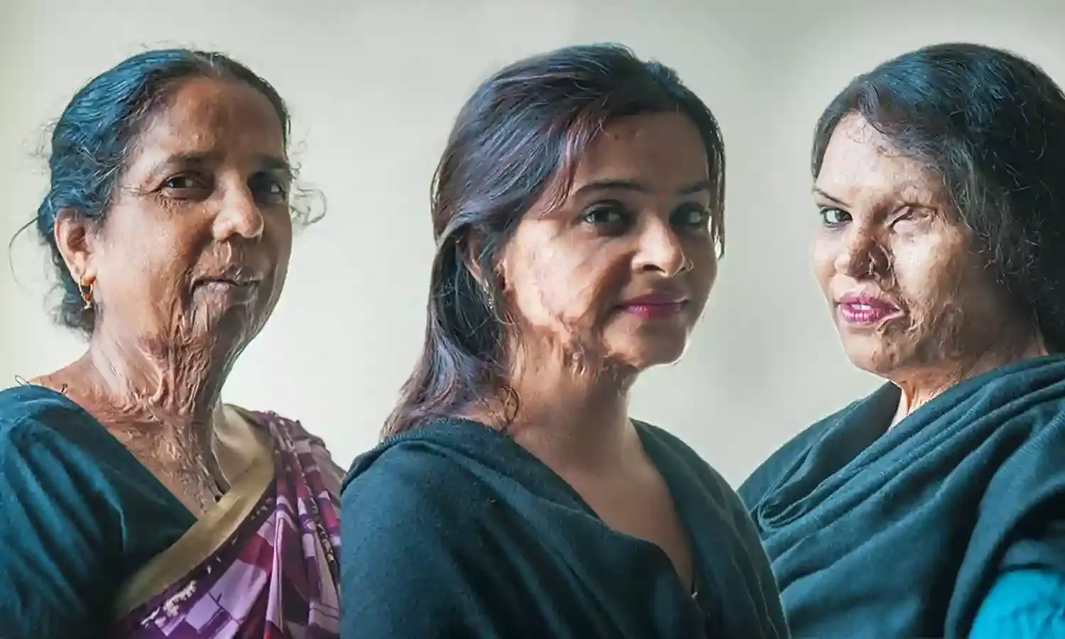 ‘They Told Me to Retract the Complaint’ - Acid Attack Survivors on the Hard Road to Justice